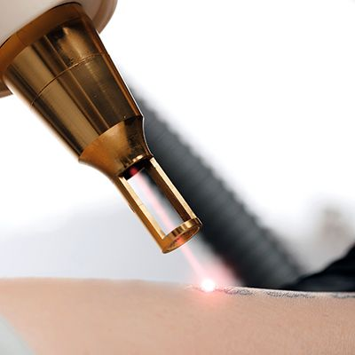 Tattoo removal industry trends